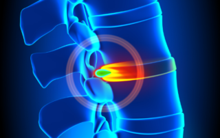 Nonsurgical Treatment Options for Disc Herniation