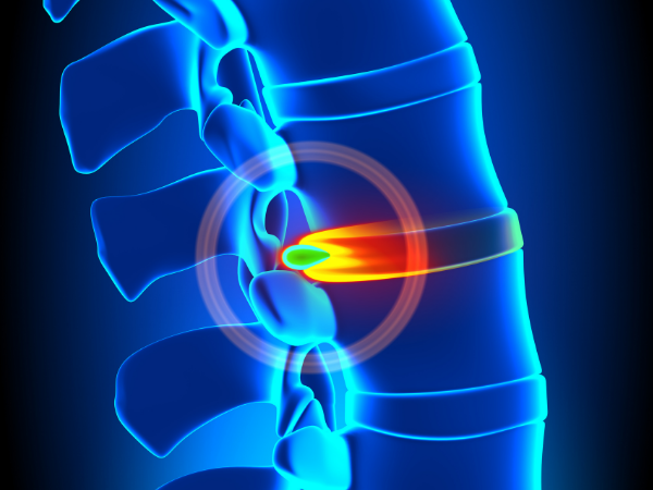 Non-surgical Treatment Options for Disc Herniation