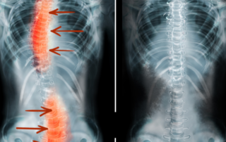 Corrective Chiropractic Care Xrays