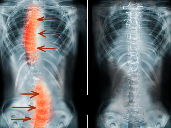 Corrective Chiropractic Care Xrays