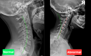 Degenerative Joint Disease