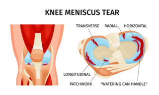 knee meniscus