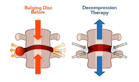 Spinal Decompression Therapy 