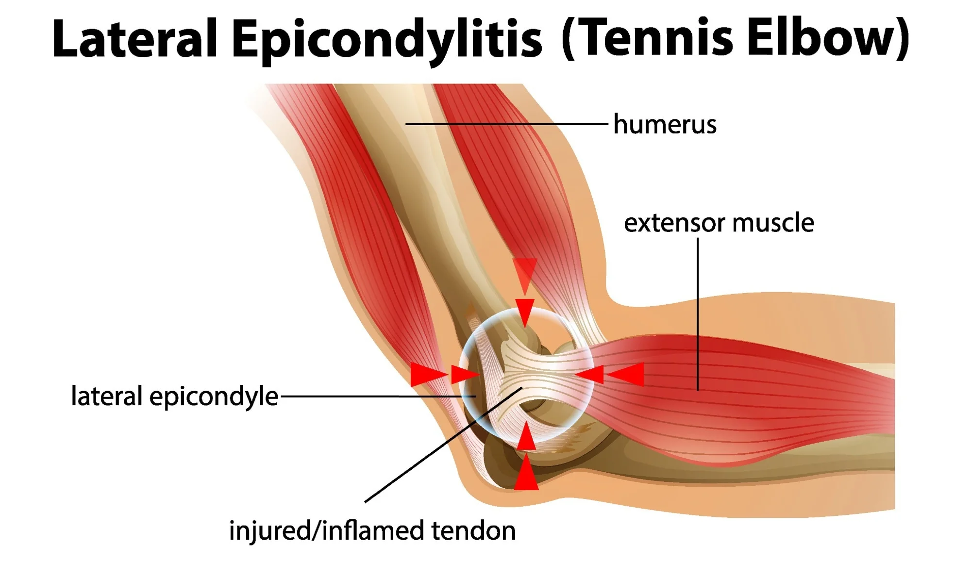 shockwave therapy for tennis elbow 